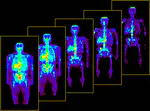 Investigation of Role of Radionuclides in Cancer Treatment