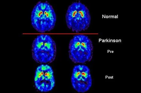 Positron Emission Tomography - PET