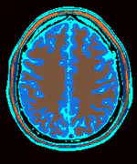 Self Supervised Learning in MR Imaging