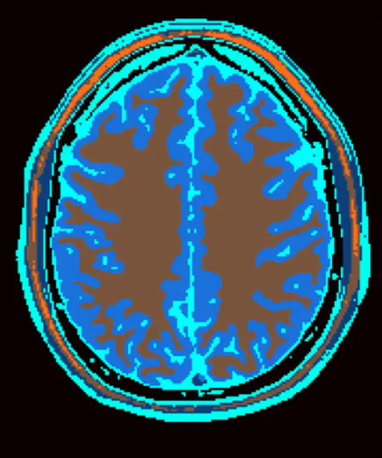 Self Supervised Learning in MR Imaging